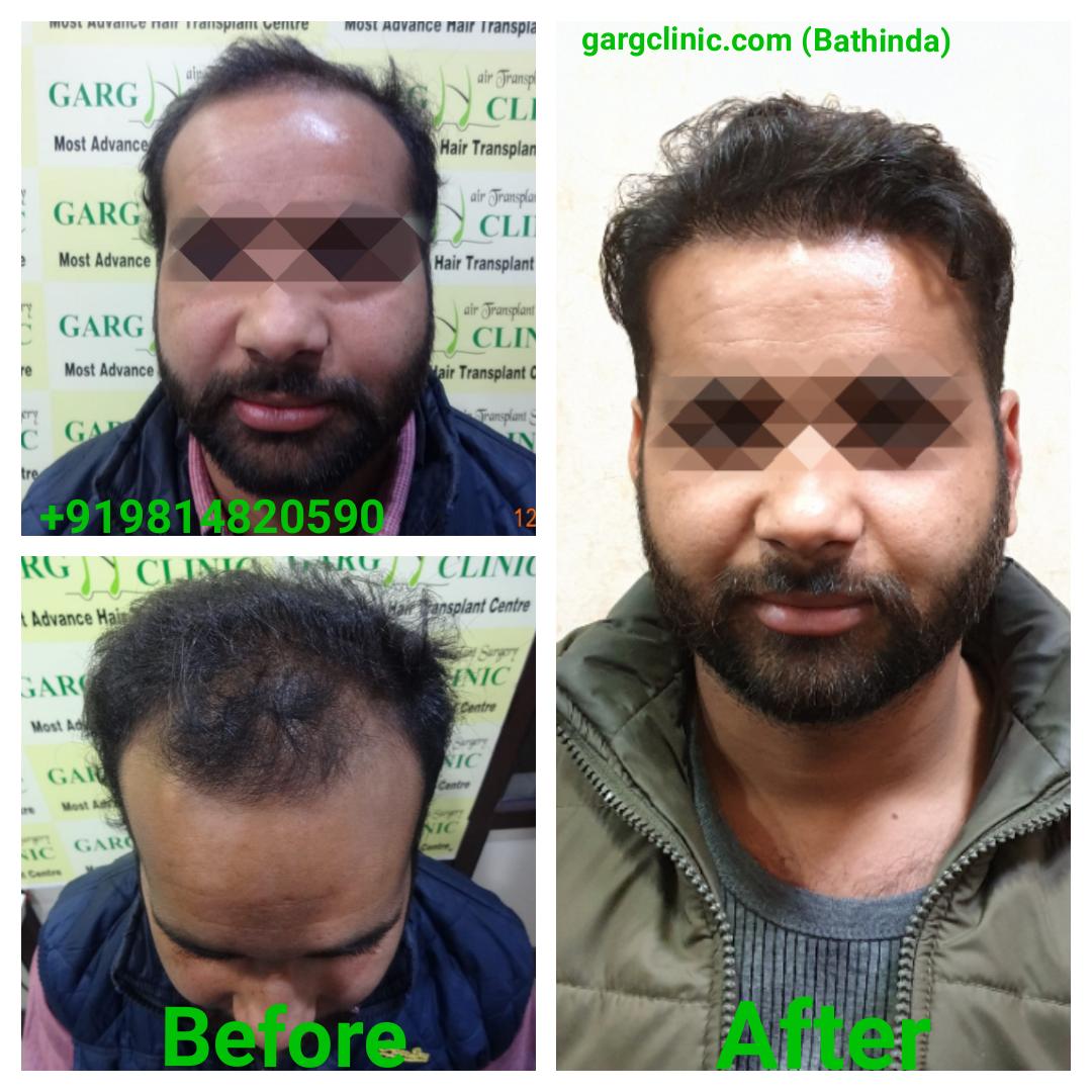 Garg Hair Transplant Clinic