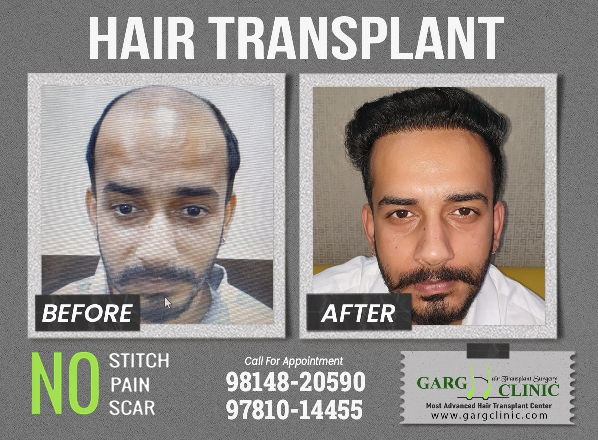 Garg Hair Transplant Clinic