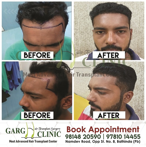 Garg Hair Transplant Clinic