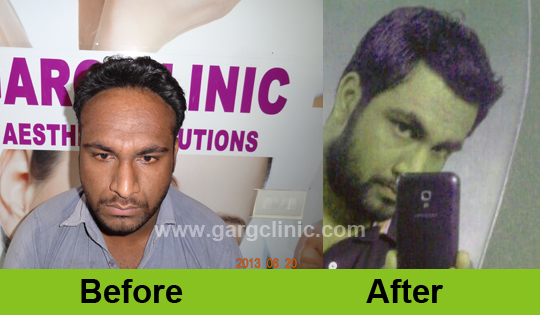 Garg Hair Transplant Clinic