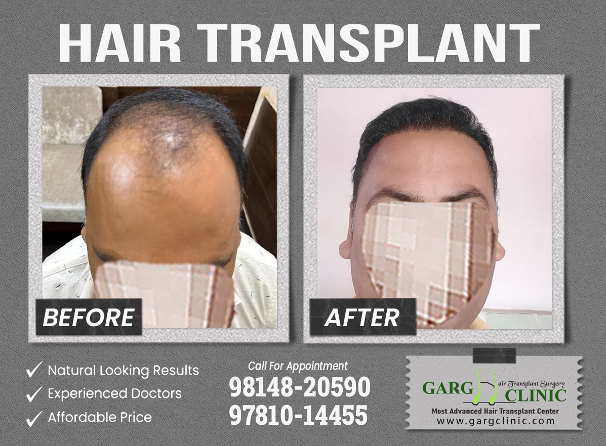 Garg Hair Transplant Clinic