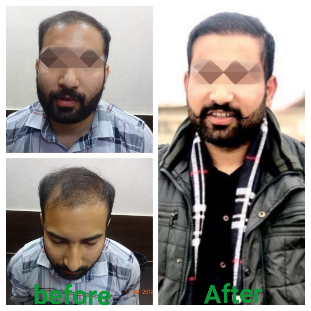 Garg Hair Transplant Clinic