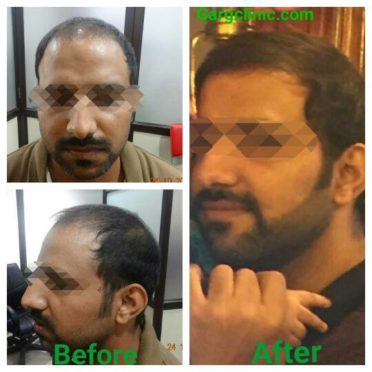 Garg Hair Transplant Clinic