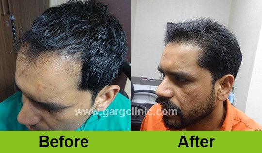 Garg Hair Transplant Clinic