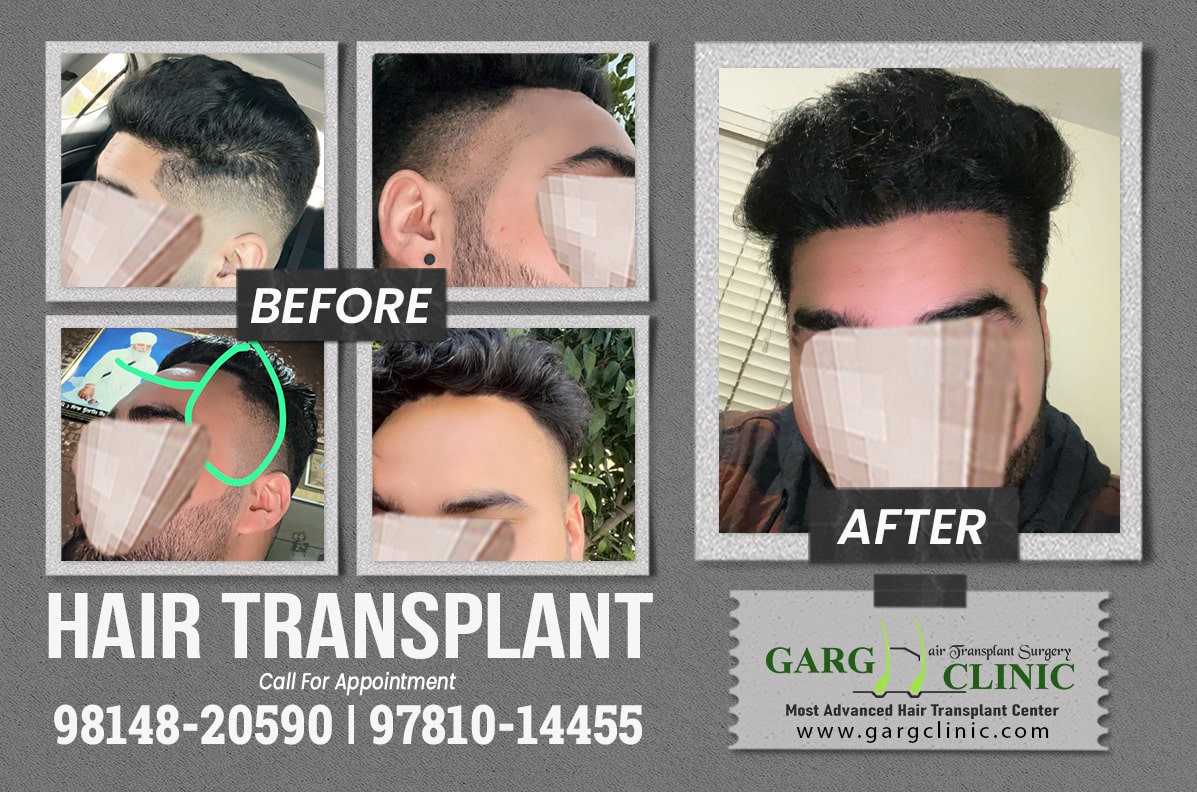 Garg Hair Transplant Clinic