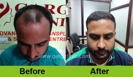 Garg Hair Transplant Clinic
