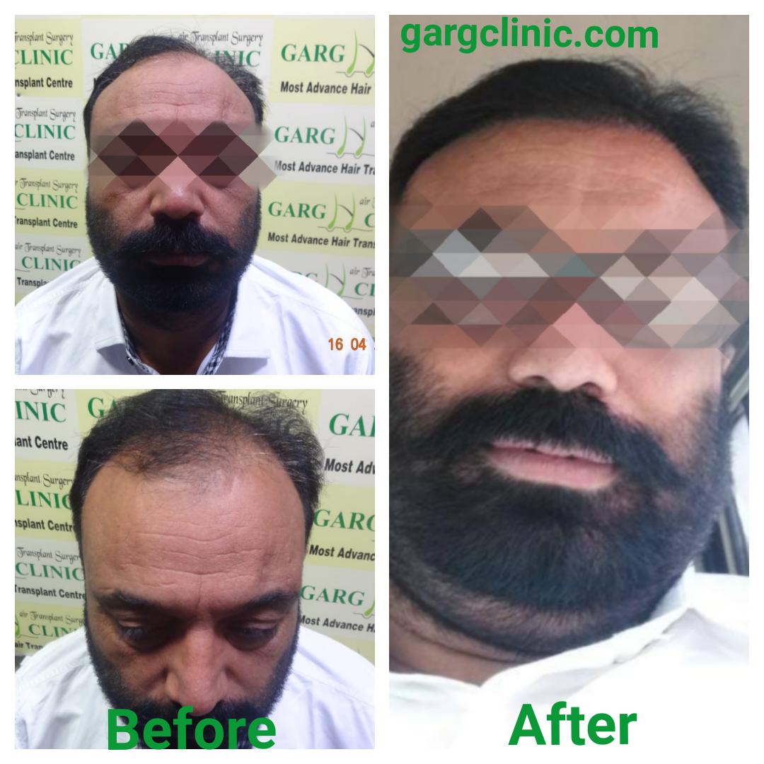 Garg Hair Transplant Clinic