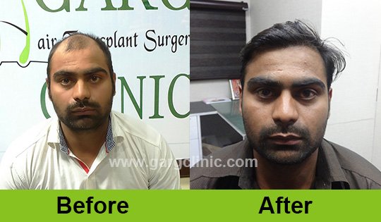Garg Hair Transplant Clinic