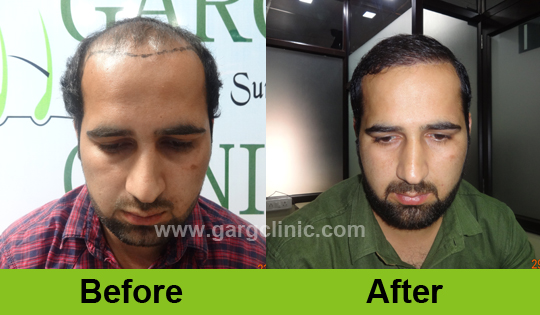Garg Hair Transplant Clinic