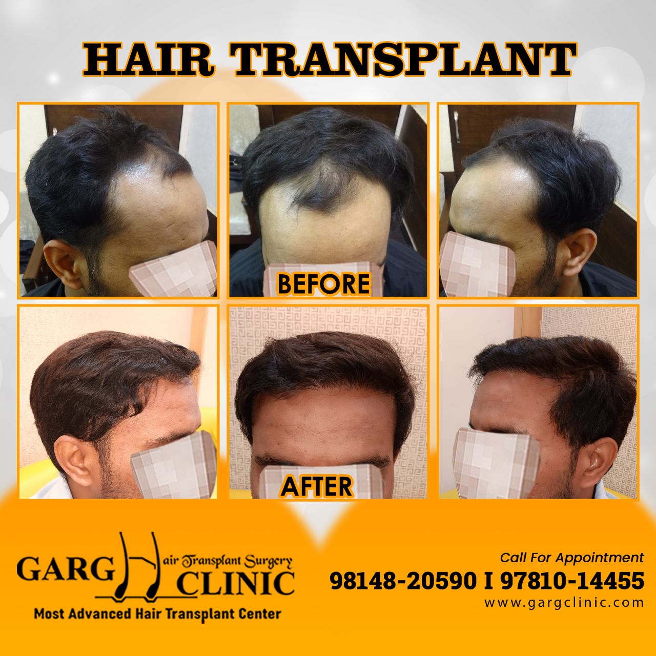 Garg Hair Transplant Clinic