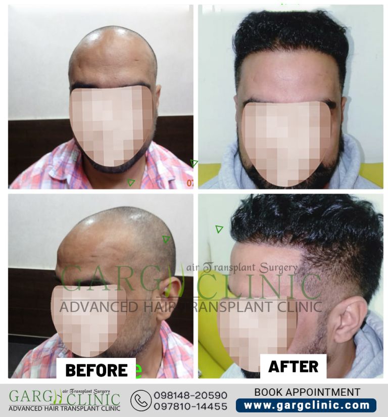Garg Hair Transplant Clinic