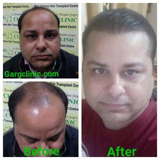 Garg Hair Transplant Clinic