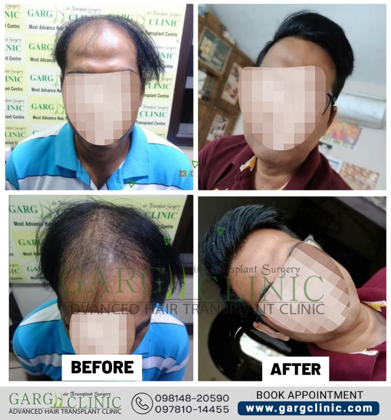 Garg Hair Transplant Clinic