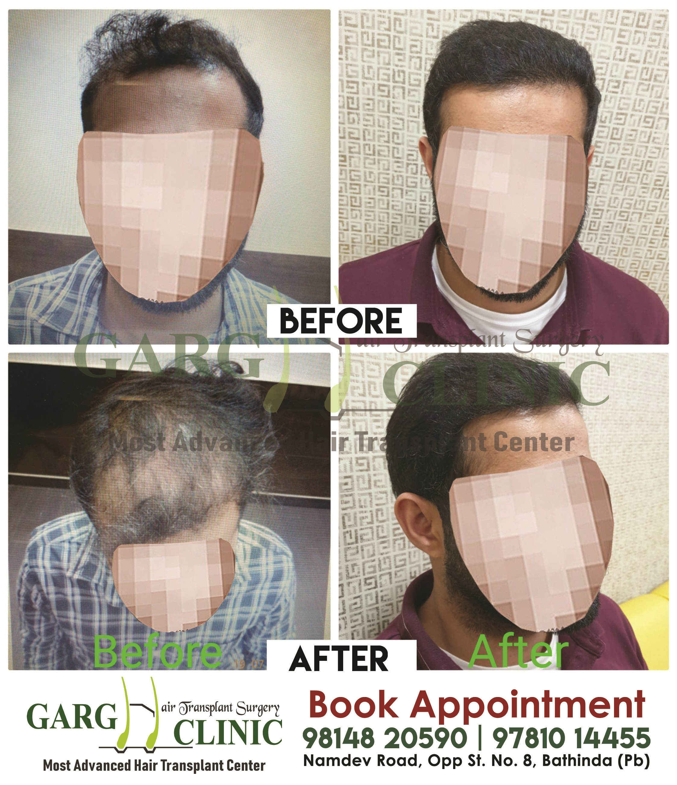 Garg Hair Transplant Clinic