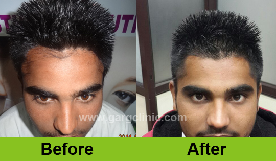 Garg Hair Transplant Clinic