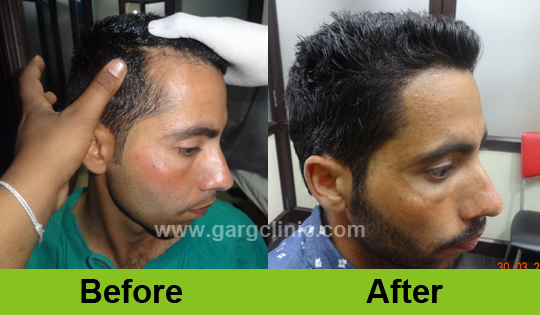 Garg Hair Transplant Clinic