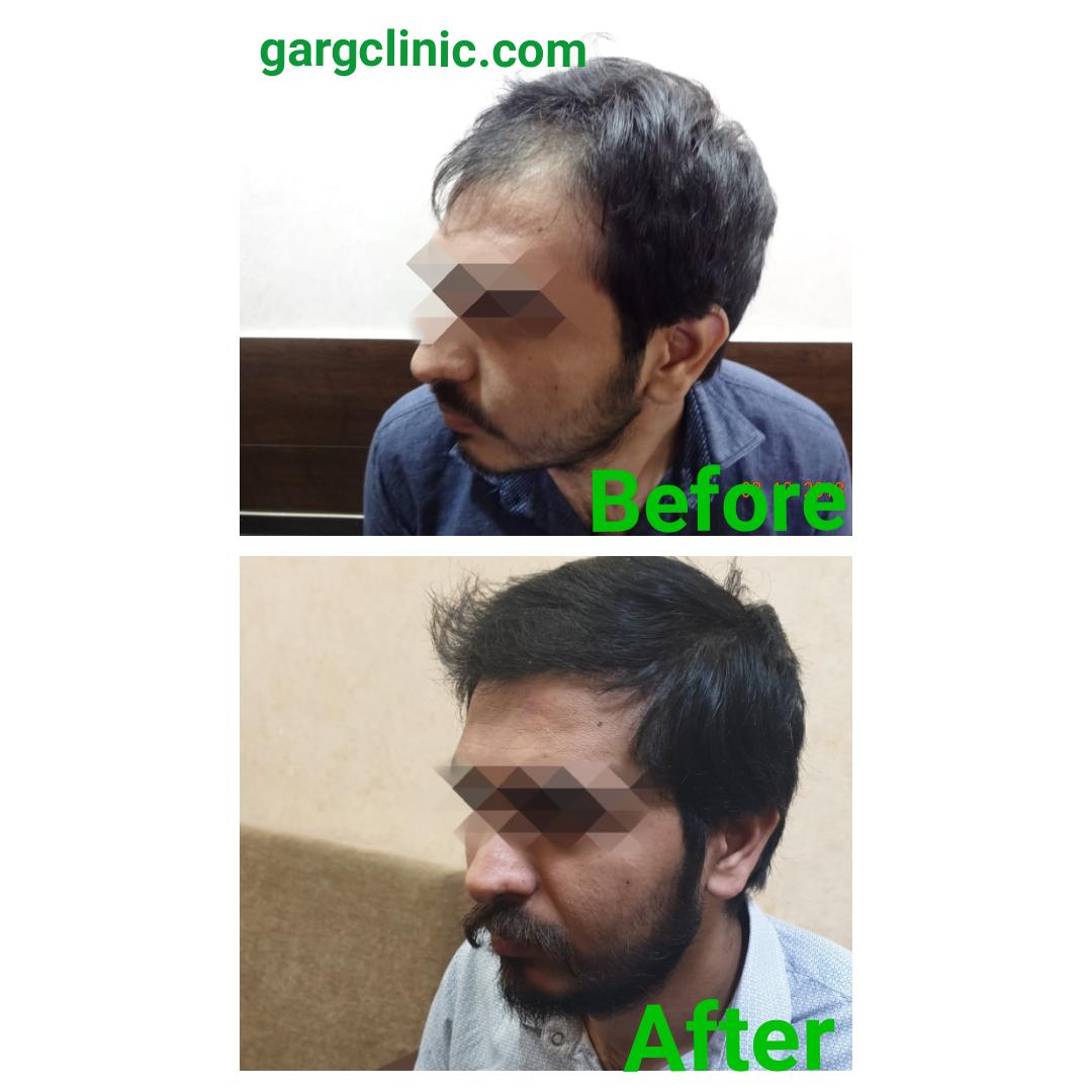 Garg Hair Transplant Clinic