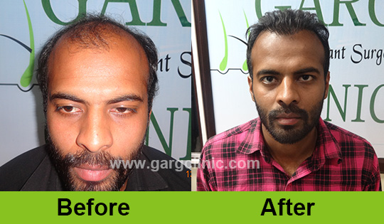 Garg Hair Transplant Clinic