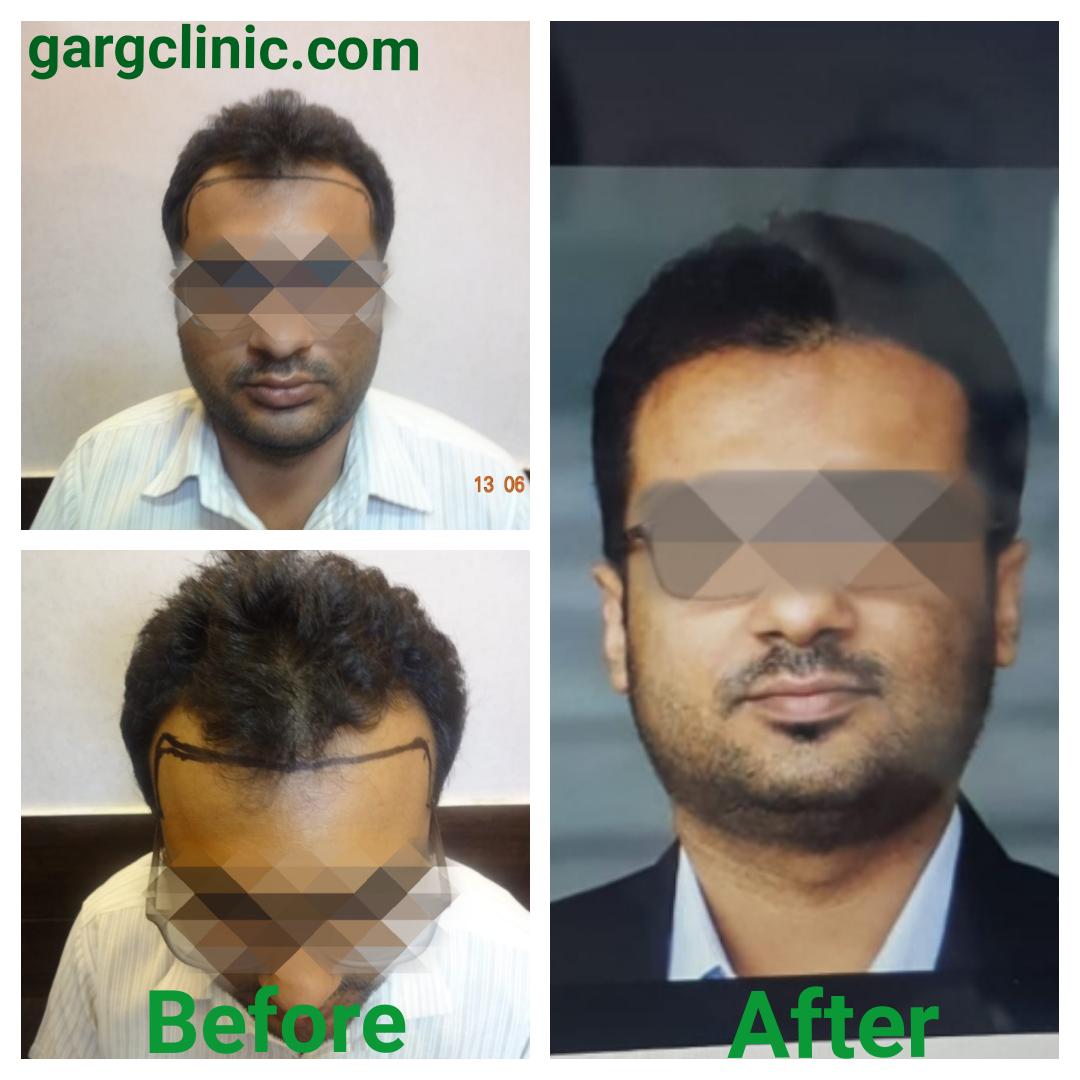 Garg Hair Transplant Clinic