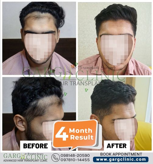 Garg Hair Transplant Clinic