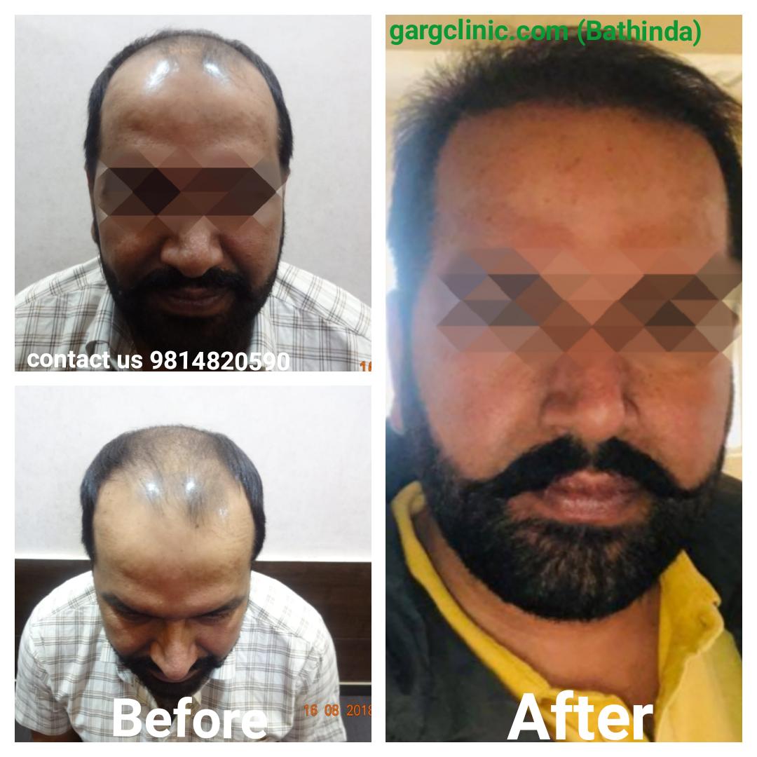 Garg Hair Transplant Clinic