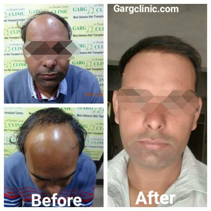 Garg Hair Transplant Clinic