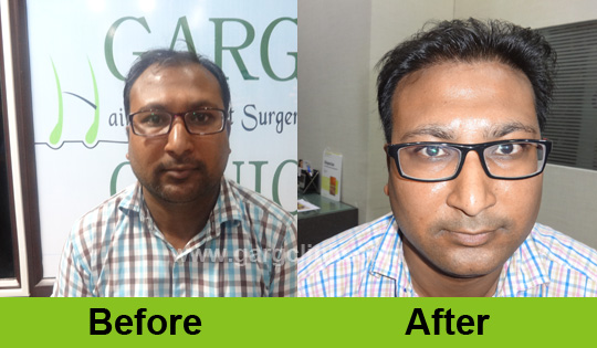 Garg Hair Transplant Clinic