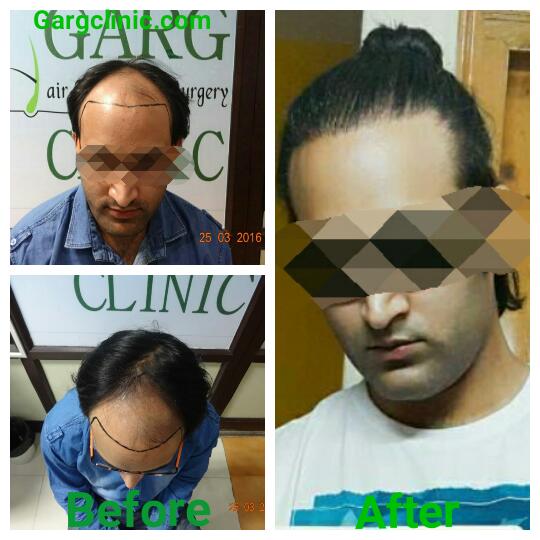 Garg Hair Transplant Clinic