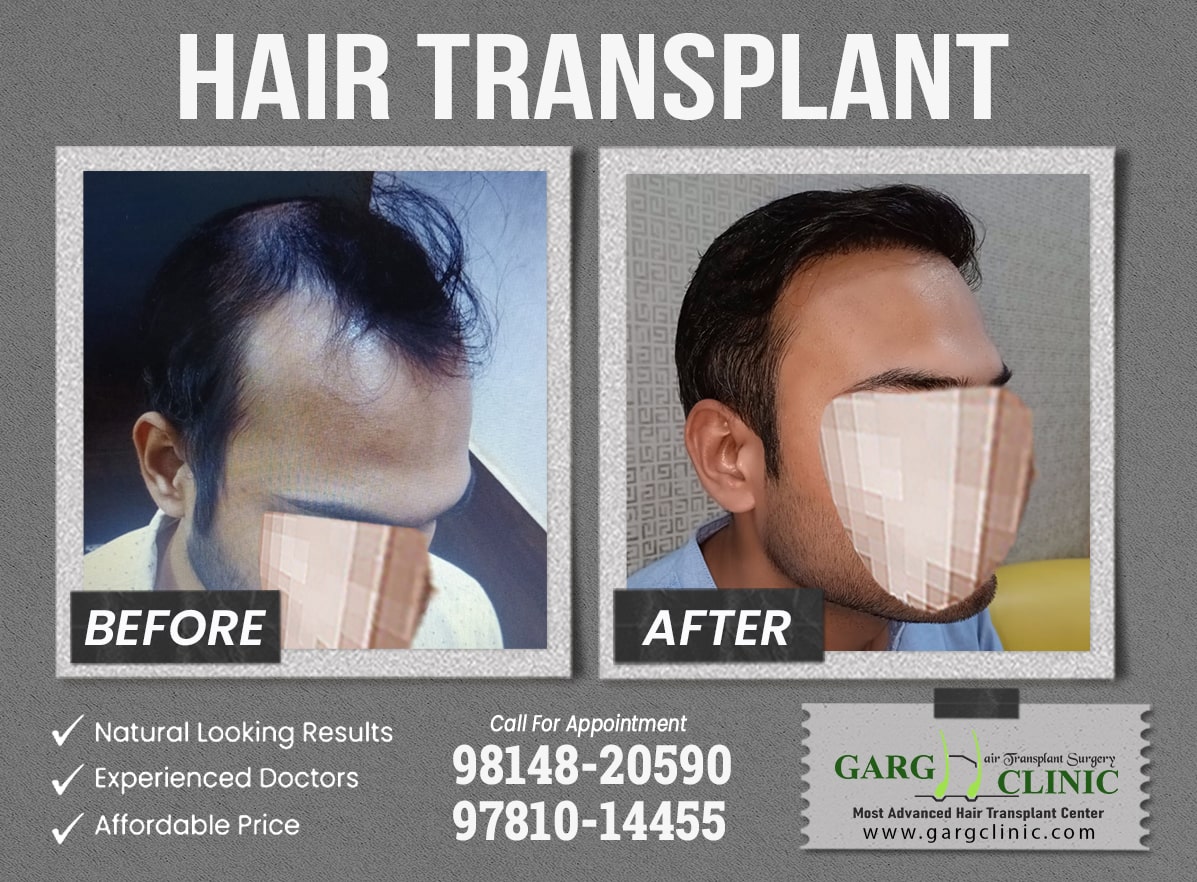 Garg Hair Transplant Clinic