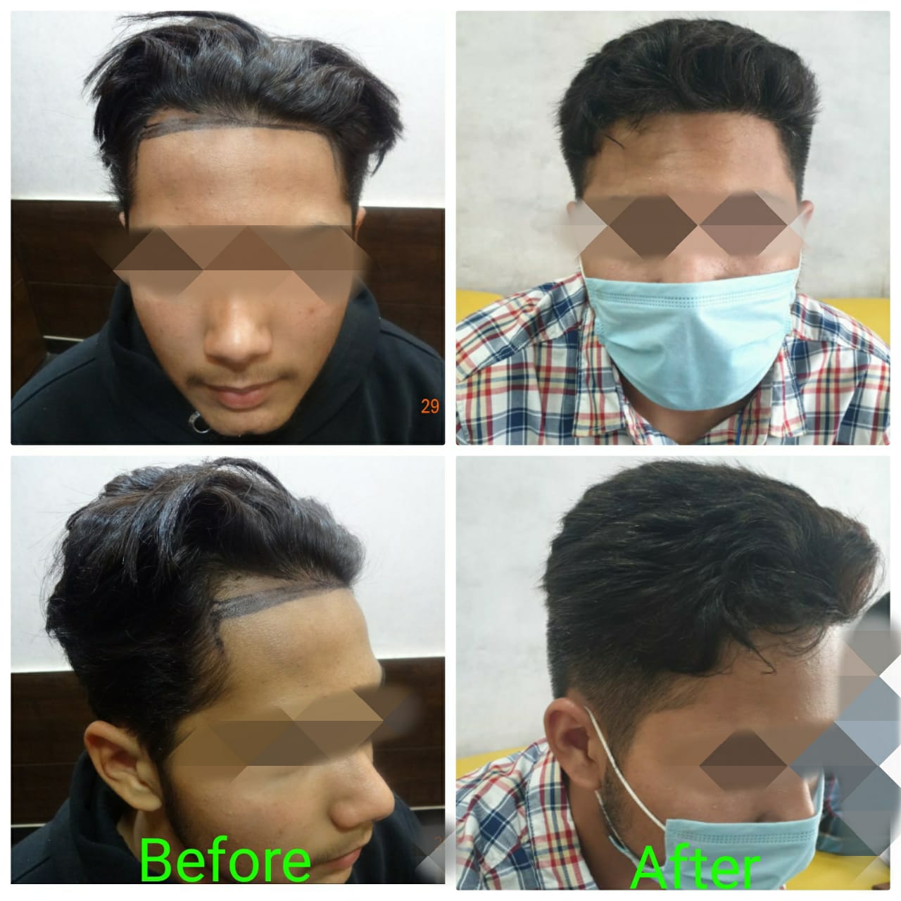 Garg Hair Transplant Clinic