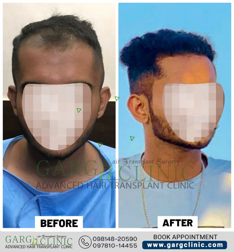 Garg Hair Transplant Clinic
