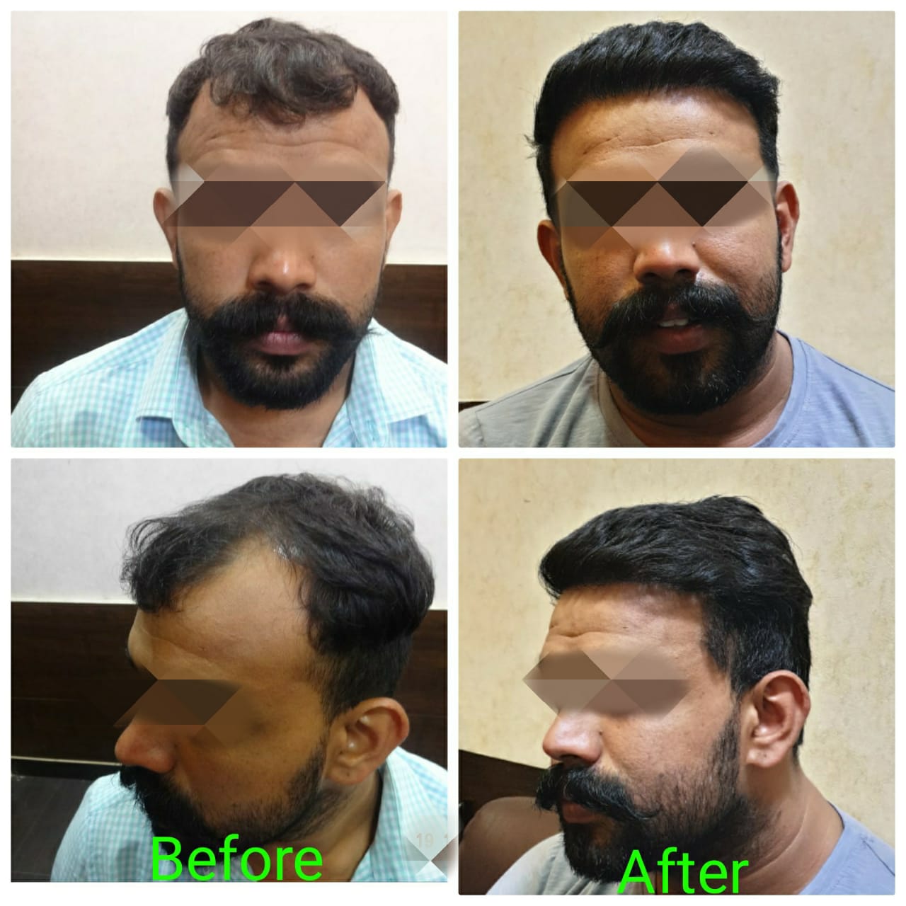 Garg Hair Transplant Clinic