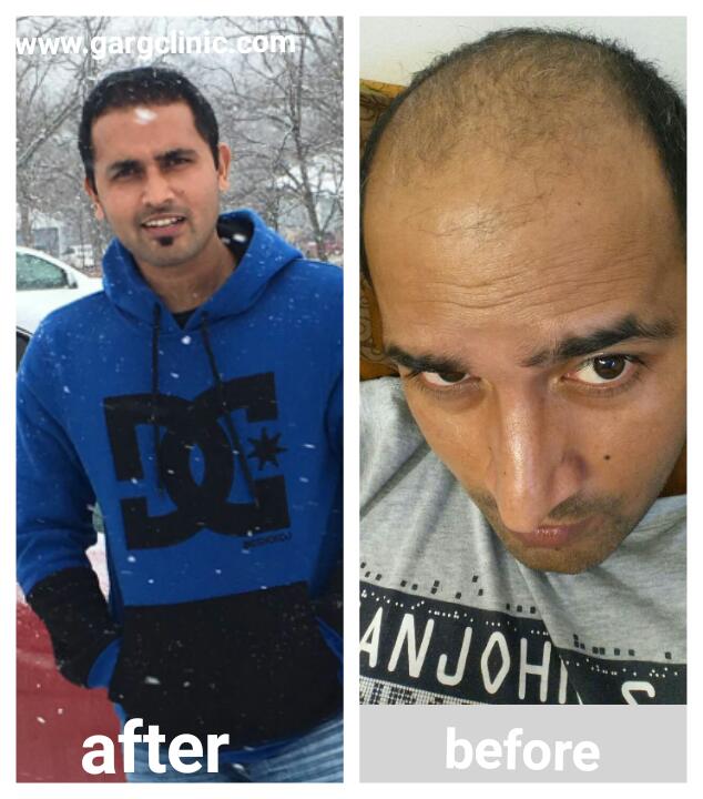 Garg Hair Transplant Clinic