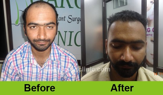 Garg Hair Transplant Clinic
