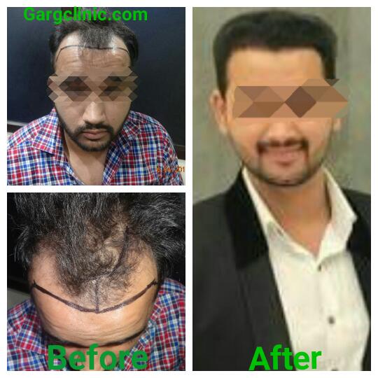 Garg Hair Transplant Clinic