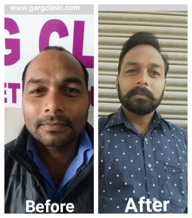 Garg Hair Transplant Clinic