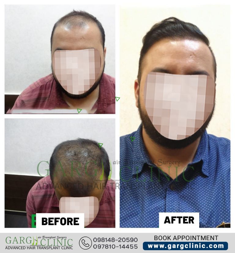 Garg Hair Transplant Clinic