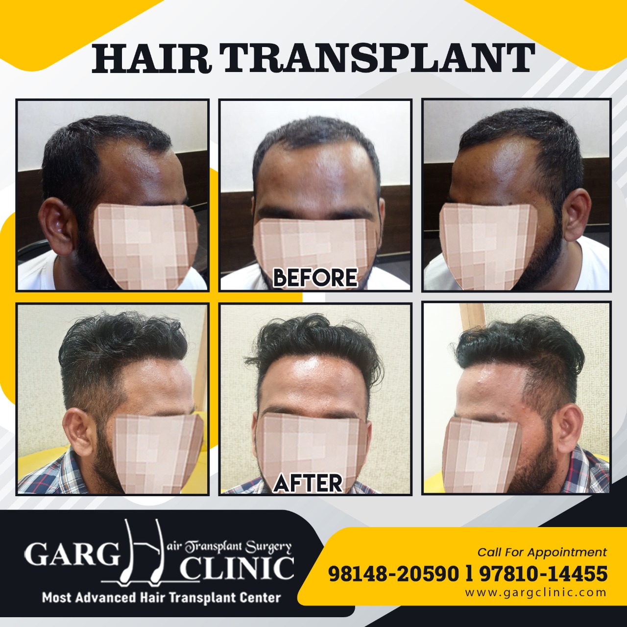Garg Hair Transplant Clinic