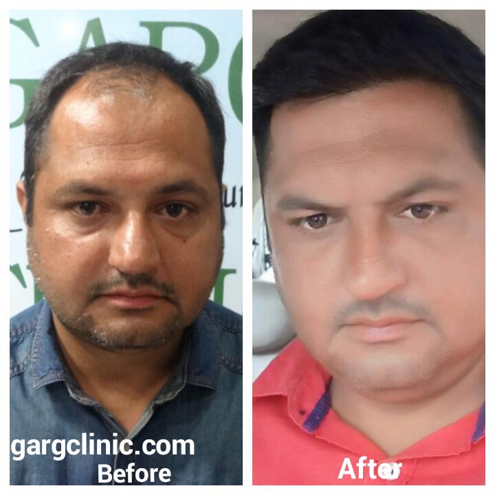 Garg Hair Transplant Clinic