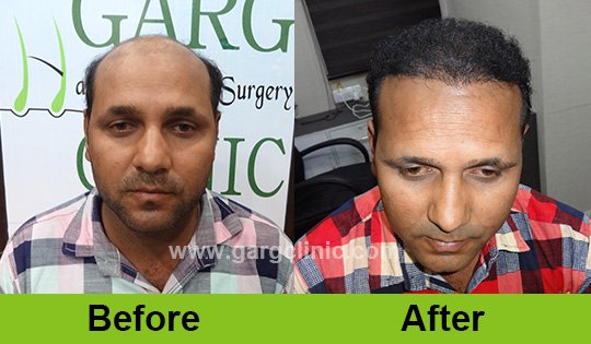 Garg Hair Transplant Clinic