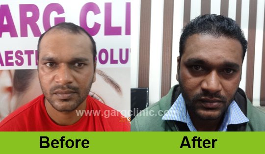 Garg Hair Transplant Clinic
