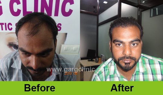 Garg Hair Transplant Clinic