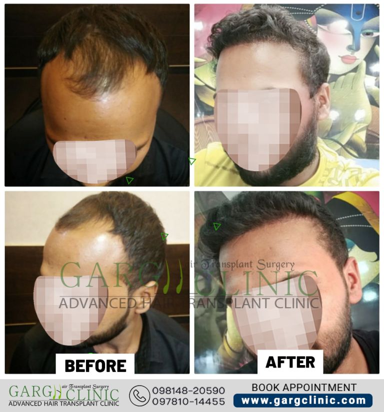 Garg Hair Transplant Clinic