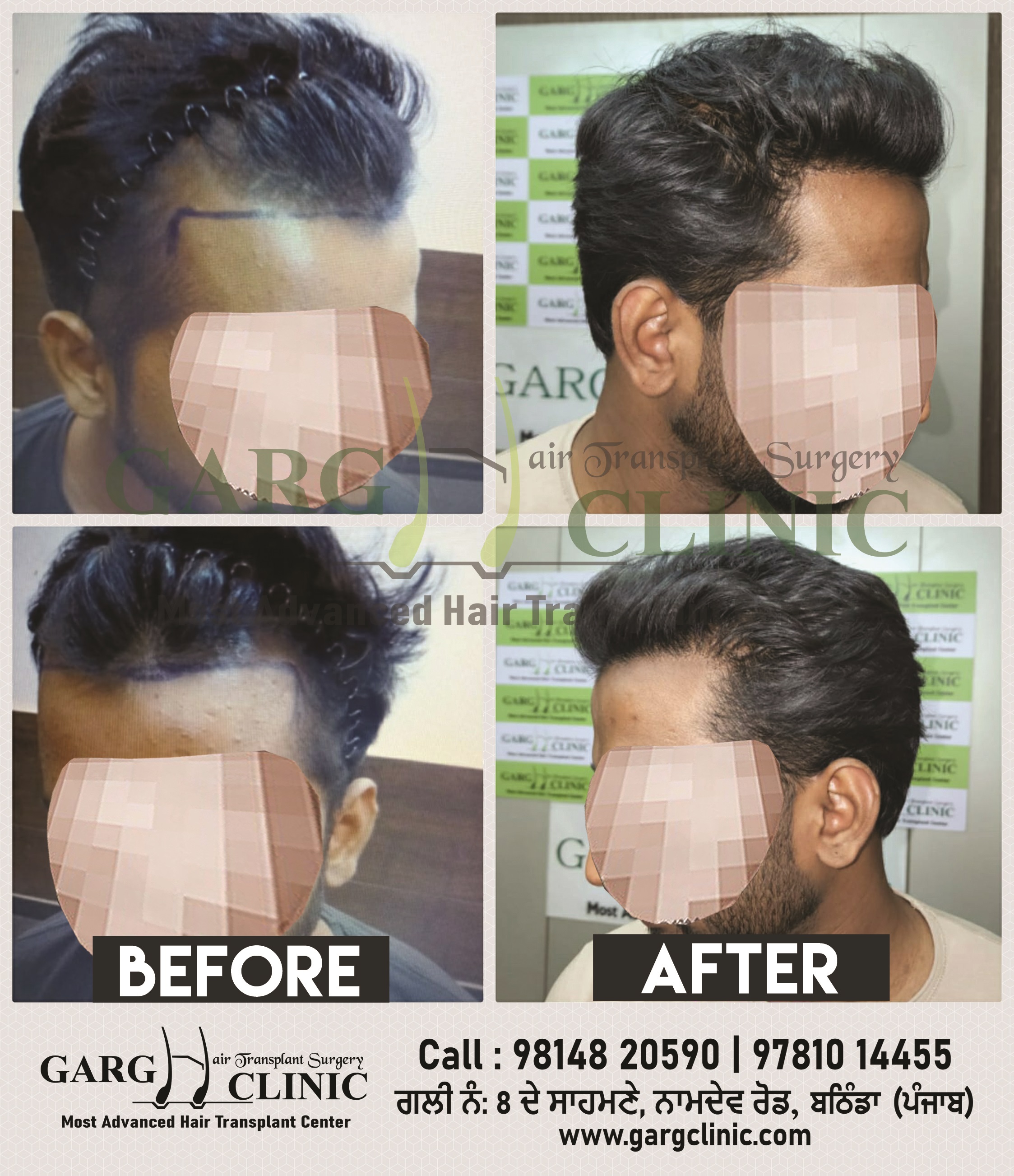Garg Hair Transplant Clinic