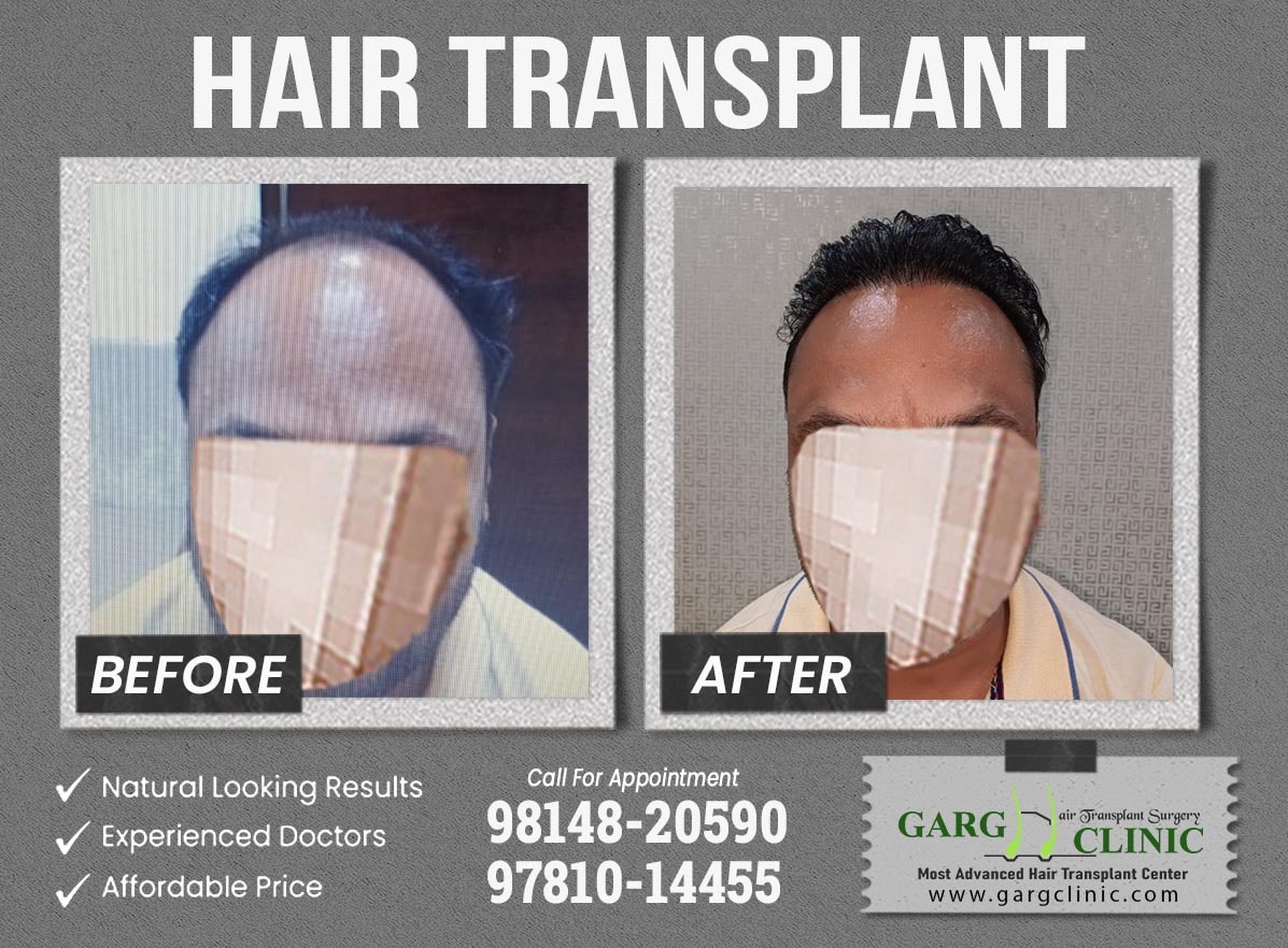 Garg Hair Transplant Clinic