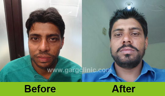 Garg Hair Transplant Clinic