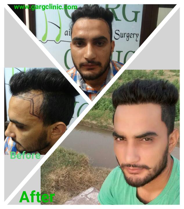 Garg Hair Transplant Clinic