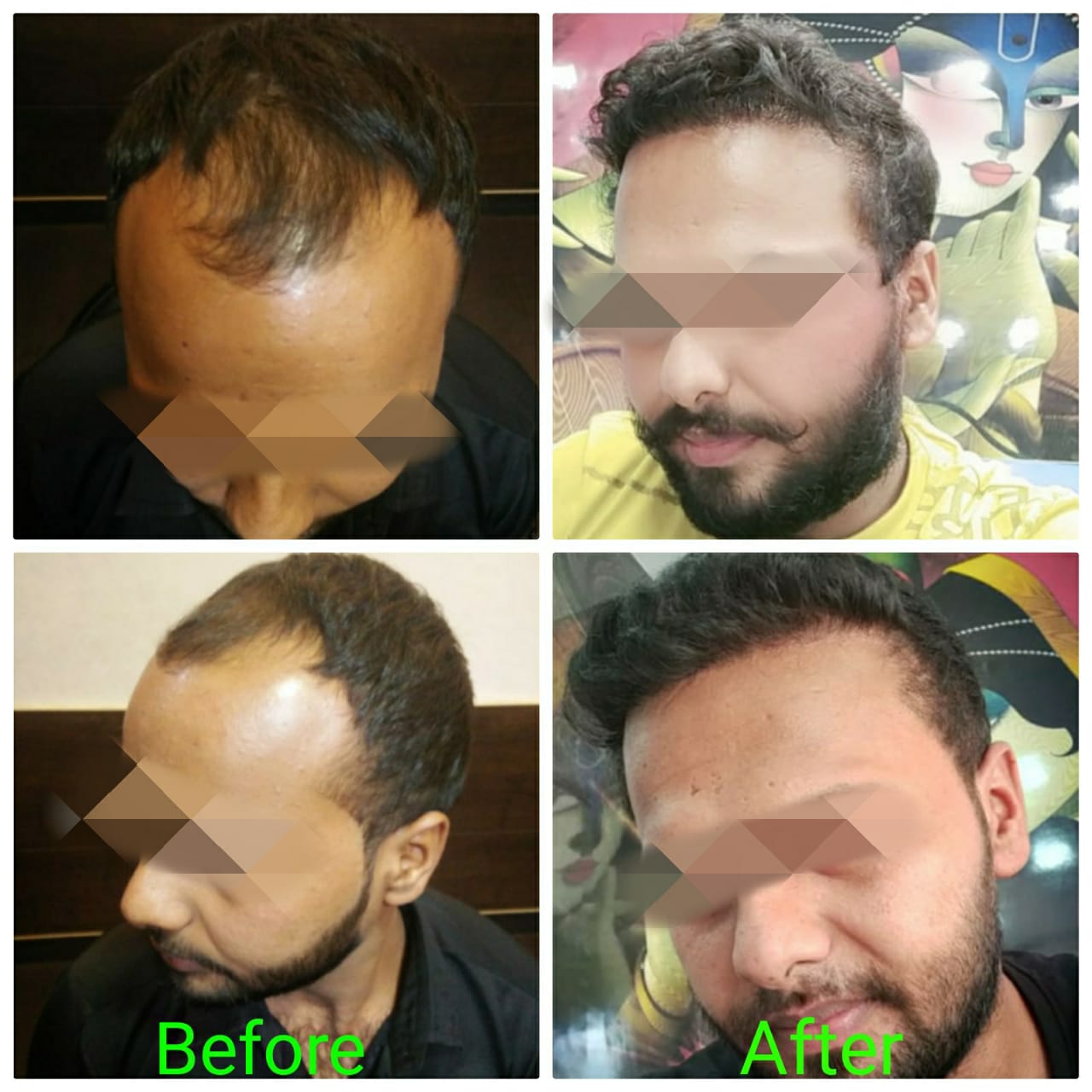 Garg Hair Transplant Clinic