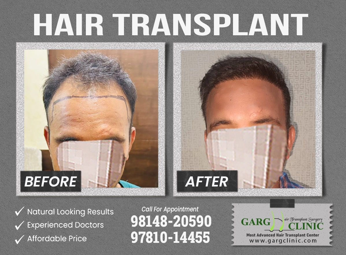 Garg Hair Transplant Clinic