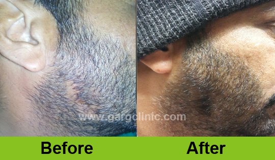 Garg Hair Transplant Clinic